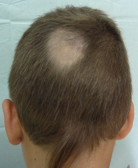 alopecia_areata.jpg